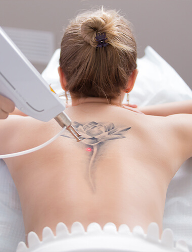 Détatouage laser sur ancien tatouage avec pigments visibles dans la peau