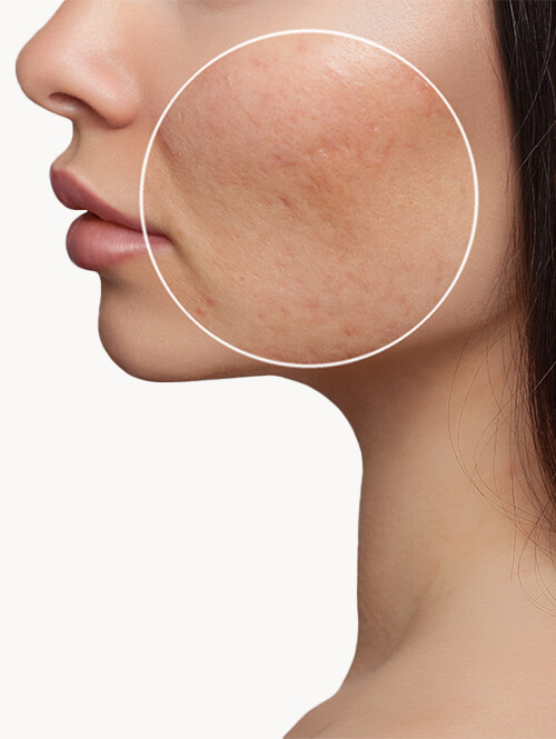 hollywood-peel-carbon-peeling-visage-lausanne (1) Soin Hollywood Peel Lausanne avec masque carbone sur le visage avant traitement laser