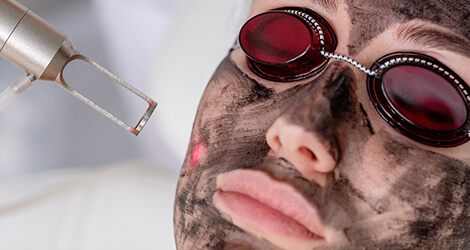 Soin Hollywood Peel Lausanne avec masque carbone sur le visage avant traitement laser