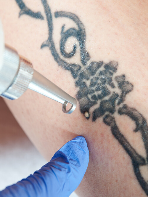 laser-detatouage-tatouage-traitement-peau (1) Traitement détatouage tatouage avec laser picoseconde sur la peau
