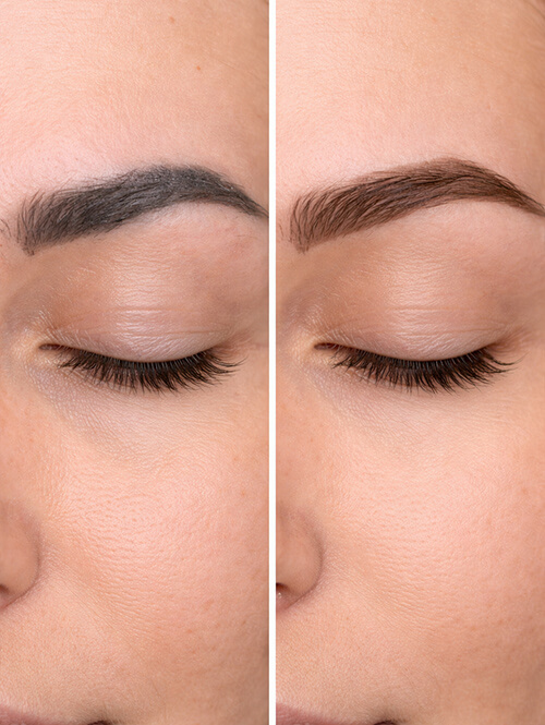 microblading-rate-correction-sourcils-laser-picoseconde-lausanne (1) Correction microblading raté avant après détatouage sourcils laser picoseconde Lausanne