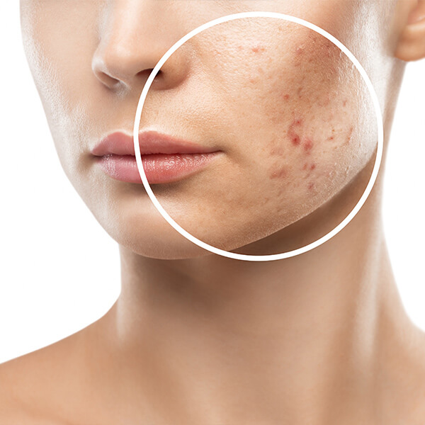 picolaser-lausanne-traitement-visage-collagene (1) Traitement visage au picolaser à Lausanne stimulant la production de collagène et le renouvellement cellulaire