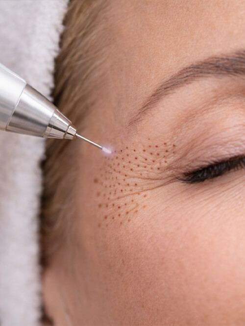 plasma-lift-lausanne-phi-ion-traitement-visage-2 (1) Plasma Lift Lausanne traitement avec stylo Phi Ion pour raffermir la peau du visage